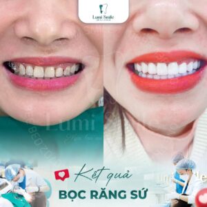 các loại răng sứ thẩm mỹ