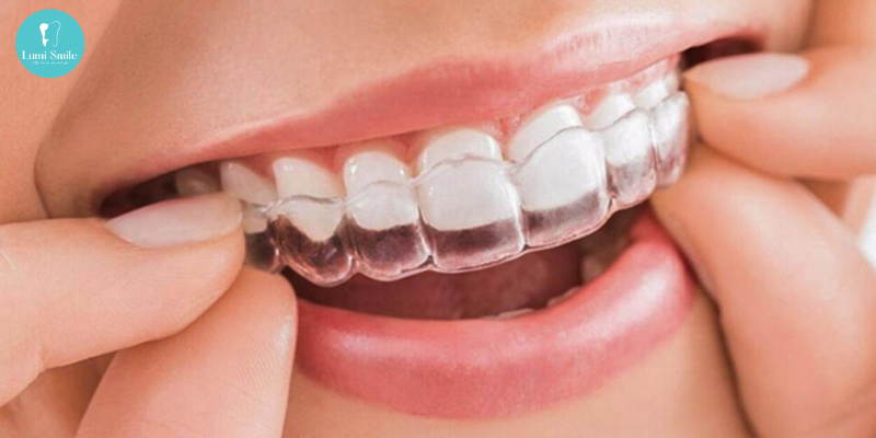 Niềng răng Invisalign