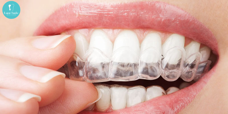 Niềng răng Invisalign