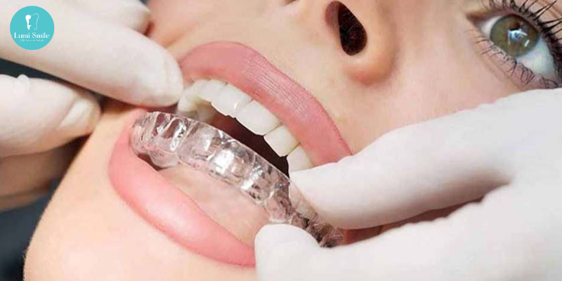 Niềng răng Invisalign