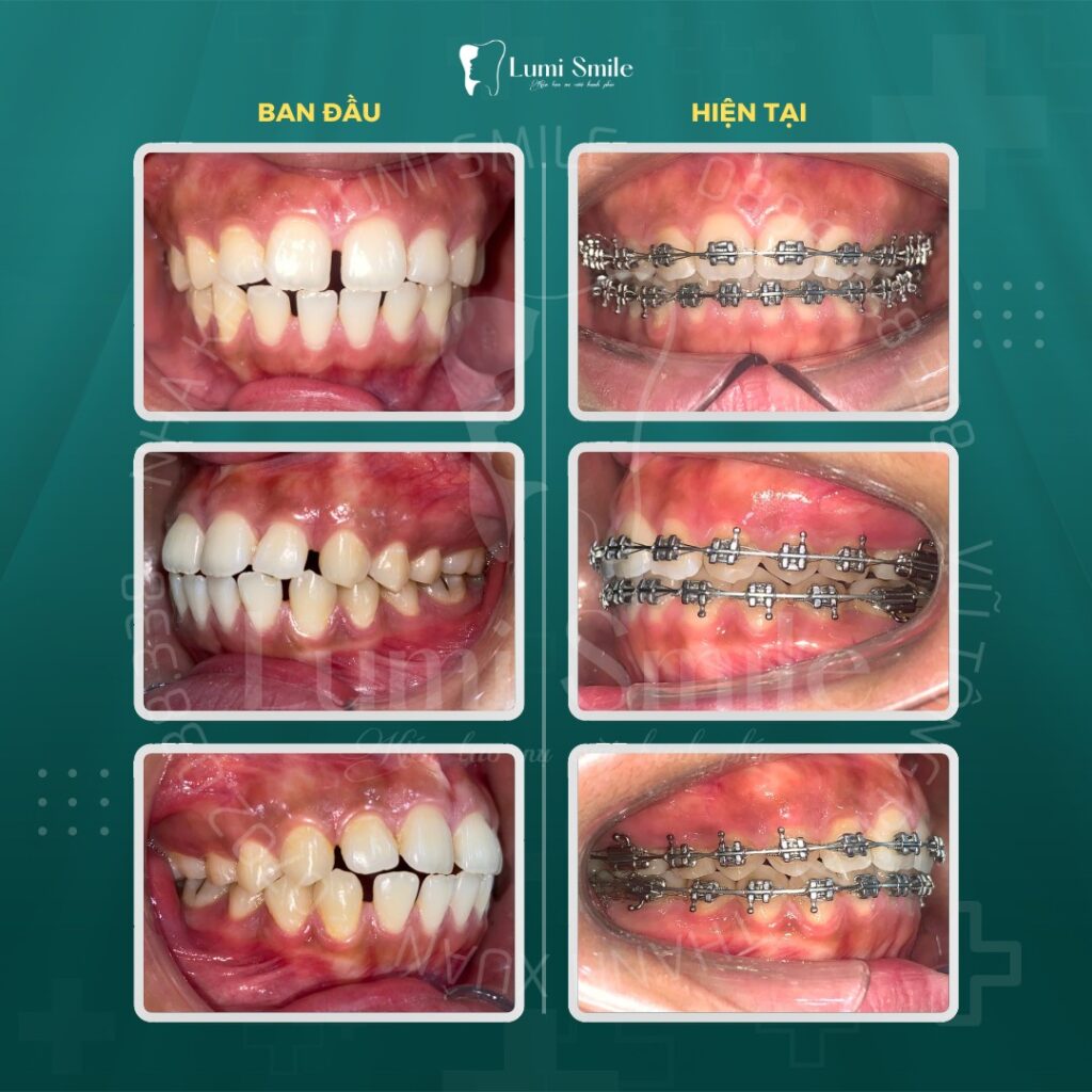 niềng răng mắc cài kim loại tự đóng